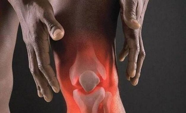 Arthrosis ass begleet vun engem entzündleche Prozess am Kniegelenk