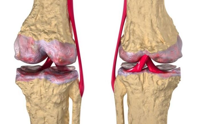 Osteoarthritis vum Kniegelenk