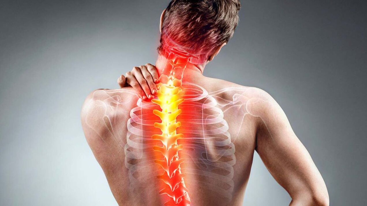 Symptomer vun der Spinal Osteochondrose